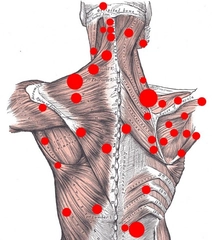 Sırt Kas Spazmı Belirtileri ve Tedavisi